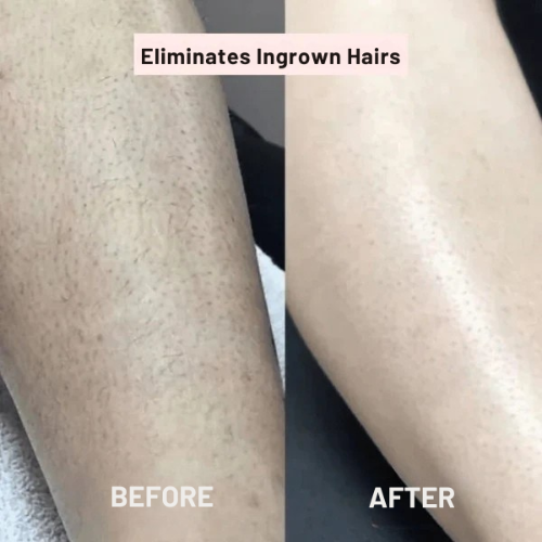 Tondeuse rasoir femme – Peau lisse sans irritation
